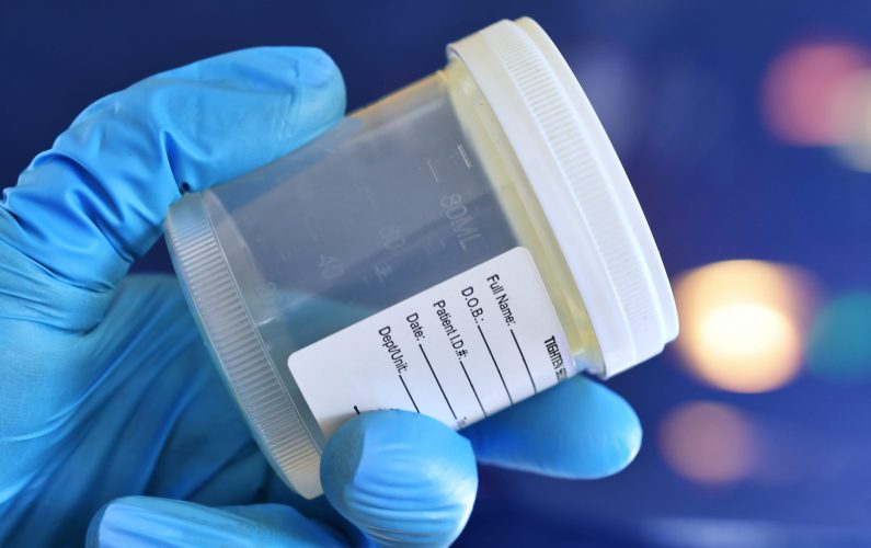 Medical personnel doctor nurse holding urine, semen or stool specimen cup for sample to be tested.