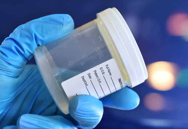 Medical personnel doctor nurse holding urine, semen or stool specimen cup for sample to be tested.